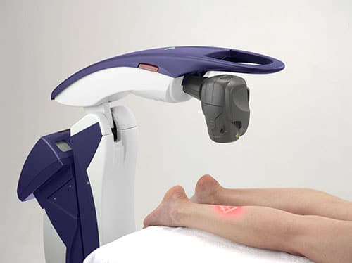 Lower Leg Laser Treatment