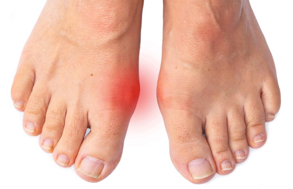 bunion spliunions and foot painnt bunion spliunions and foot painnt