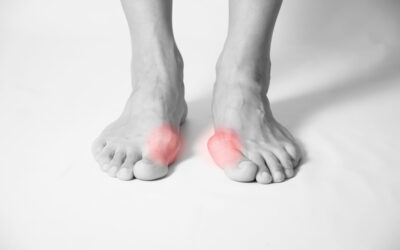 What Can I Do to Relieve My Bunion Pain?
