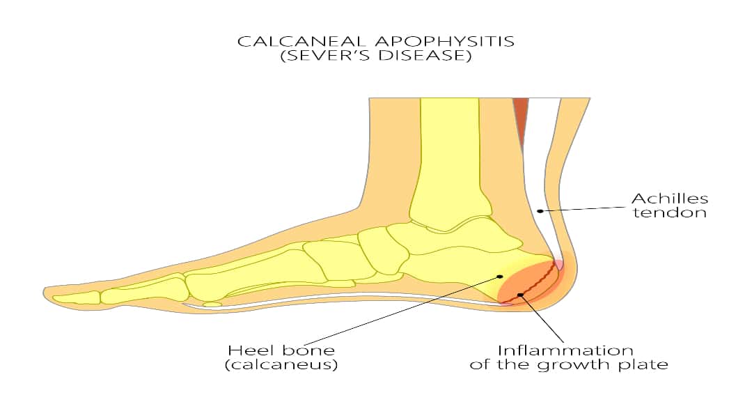 recover quickly from heel pain
