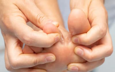 What You Need to Know About Athlete’s Foot