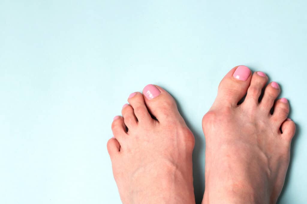 What is the Best Treatment for Bunions? Community Foot Clinic of