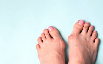 What is the Best Treatment for Bunions?