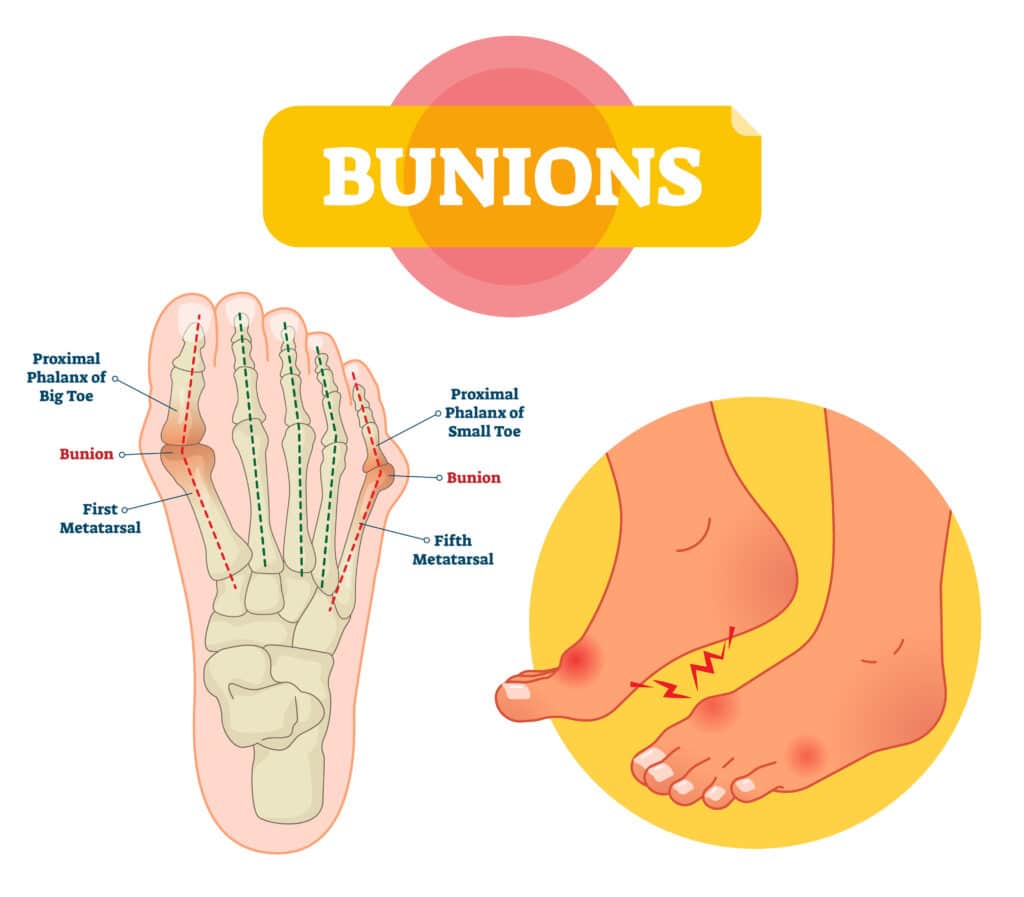Bunions vector illustration. Labeled feet bone disorder explanat