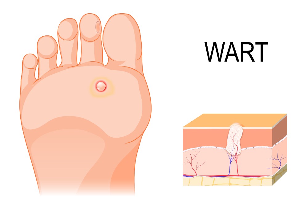 Plantar warts shown on surface of foot and under the skin