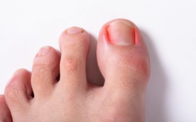 Everything You Need to Know About Ingrown Nails