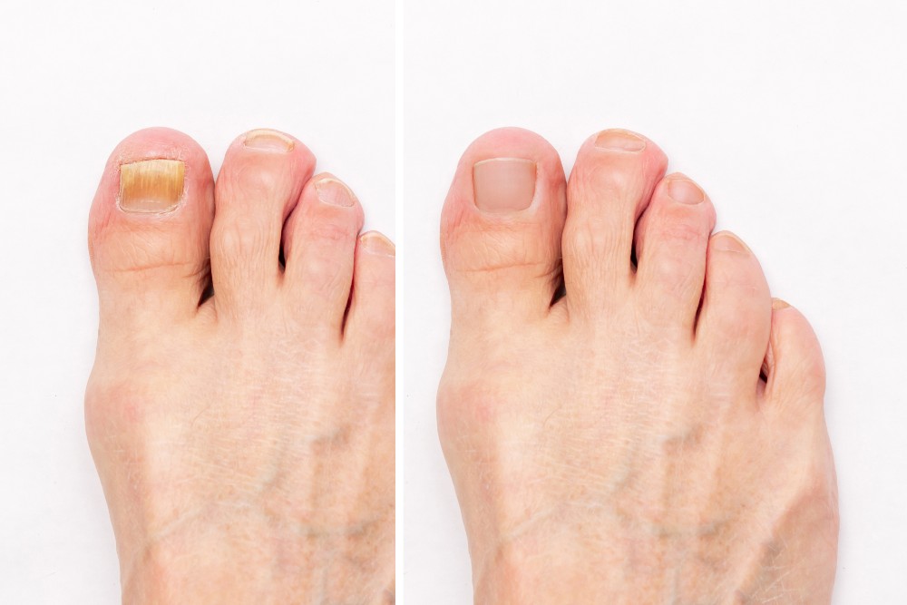 Before and after toenail fungus treatment
