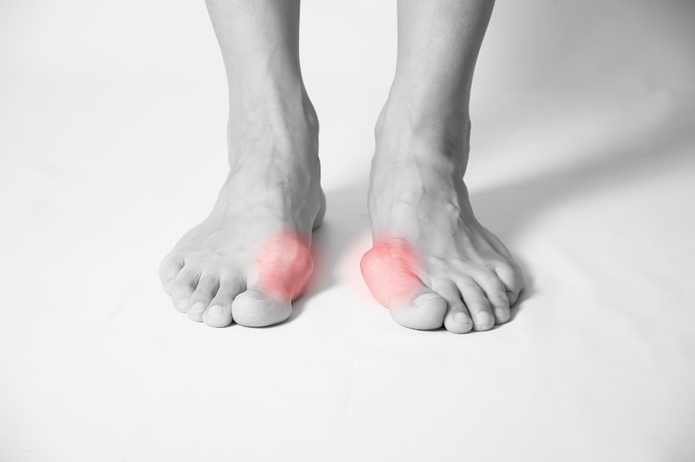 Feet showing bunions causing big toe pain