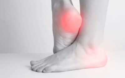 Complications of Untreated Heel Spurs